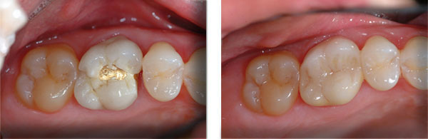 Before & After: Crowns